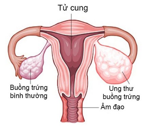 Dấu hiệu nhận biết sớm bệnh ung thư buồng trứng