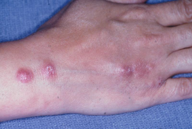 Nấm Sporotrichosis - bệnh dễ gặp vào mùa xuân