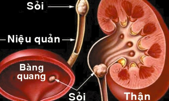 Y học cổ truyền trị sỏi niệu do thấp nhiệt