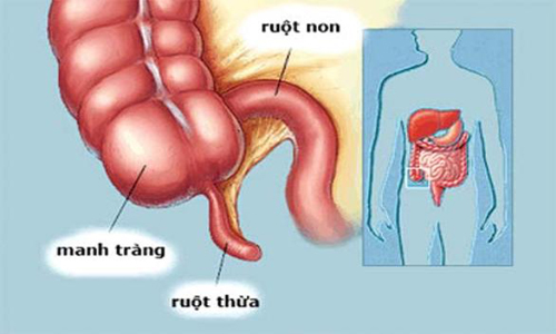 Y sĩ mách bạn cách nhận biết viêm ruột thừa