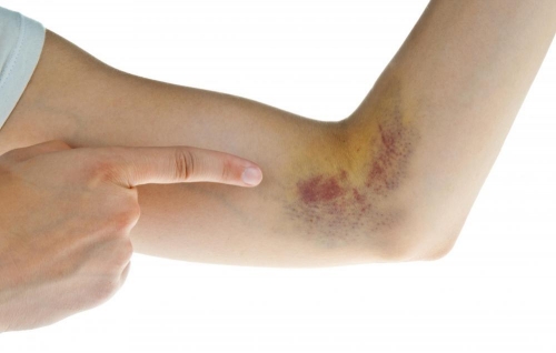 Cảnh giác với những vết bầm tím trên da