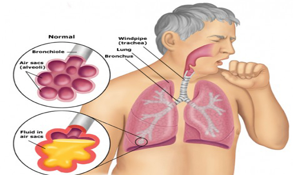 Những biến chứng của bệnh lao phổi cần cảnh giác