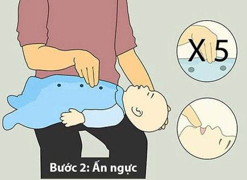 Điều dưỡng viên Hướng dẫn sơ cứu trẻ bị hóc