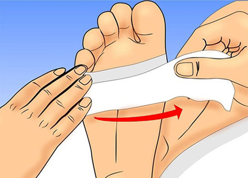Những Lưu ý khi thực biện phương pháp Cố định băng