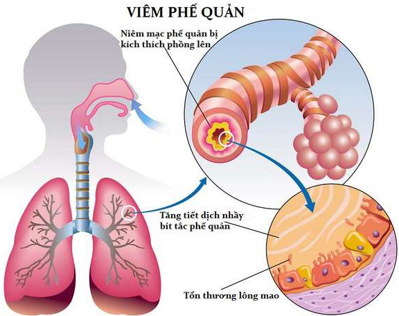 Bệnh viêm phế quản thường gặp ở trẻ nhỏ