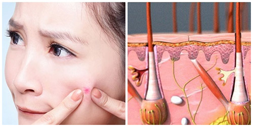 Mụn trứng cá do nhiều nguyên nhân gây ra
