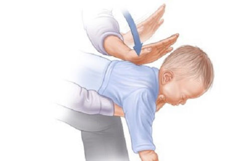 Hướng dẫn sơ cứu trẻ nhỏ bị hóc Hướng dẫn sơ cứu trẻ nhỏ bị hóc