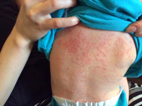 Kháng thể sởi ở phụ nữ có thai và trẻ nhỏ thấp