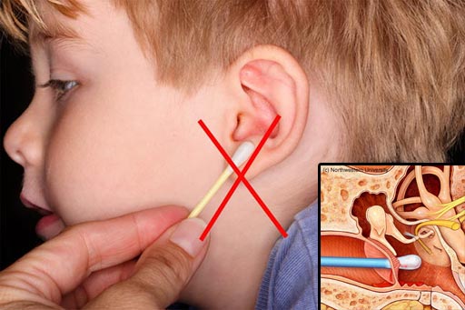 Tác hại của lấy ráy tai đến sức khoẻ Tác hại của lấy ráy tai đến sức khoẻ