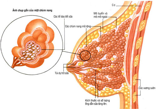 Tắc tia sữa khiến mẹ mệt mỏi, khiến con không có sữa để bú Tắc tia sữa khiến mẹ mệt mỏi, khiến con không có sữa để bú