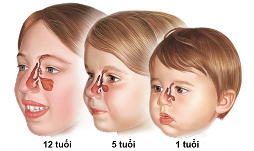 viem-xoang-o-tre-em
